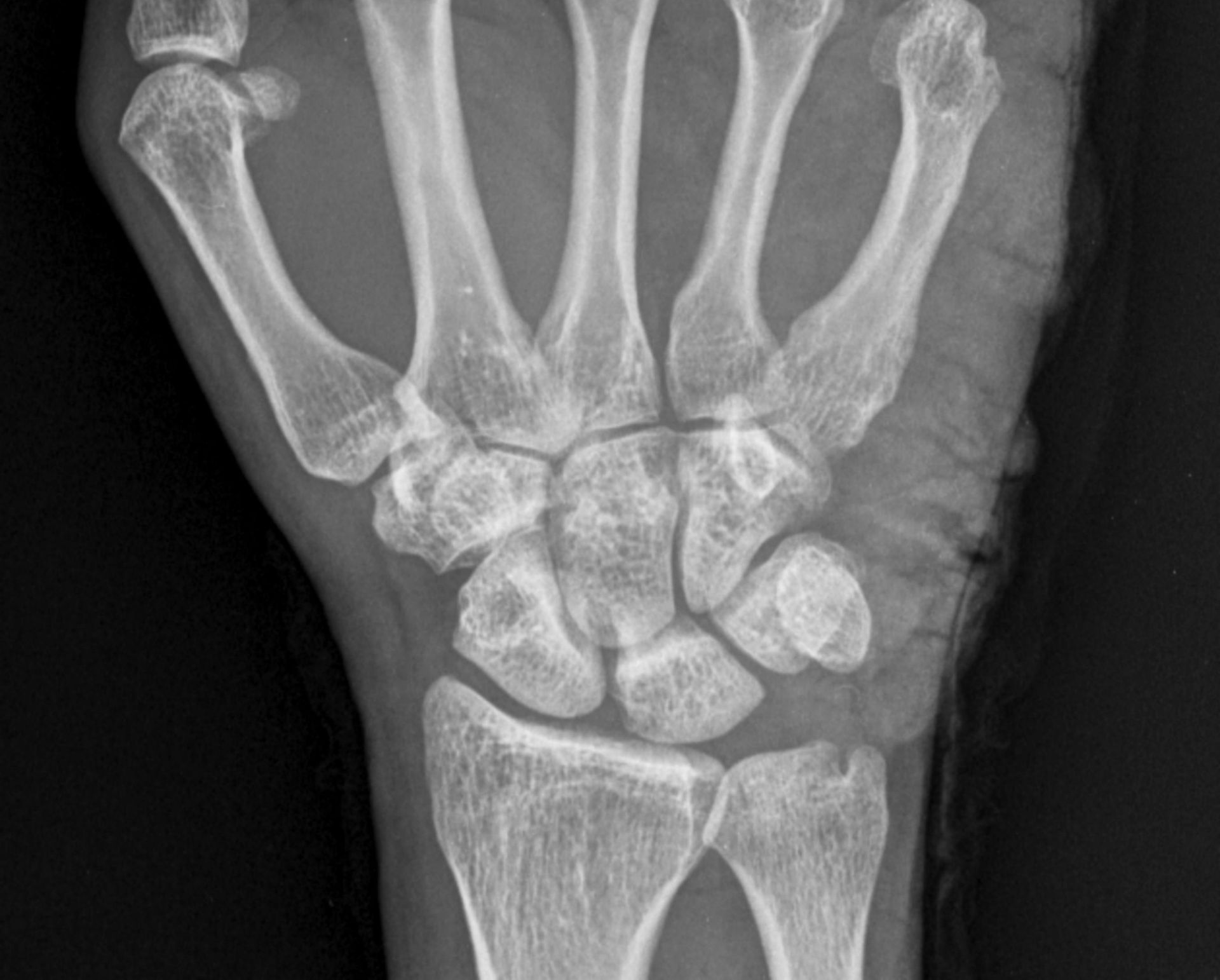 Can a Chiropractor Help with Carpal Tunnel Syndrome